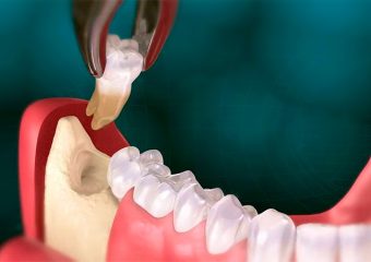 دلایل تیر کشیدن دندان | بهترین دندانپزشک زیبایی اصفهان