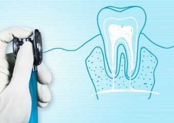 روش های درمان بی دندانی | بهترین ایمپلنت اصفهان