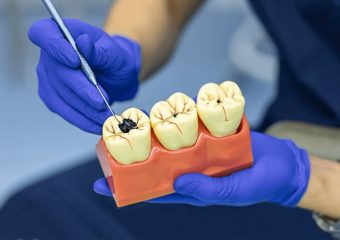 عوامل خرابی دندان ها | بهترین دندانپزشک زیبایی اصفهان