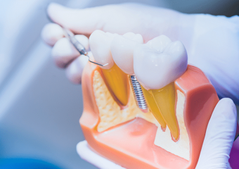 مشکلات ایمپلنت دندان | بهترین دندانپزشک زیبایی اصفهان