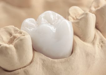 مقایسه روکش دندان زیرکونیا و PFM | بهترین دندانپزشک زیبایی اصفهان