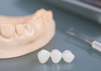 کاربرد های لمینت فوری دندان | بهترین ایمپلنت اصفهان