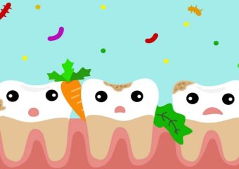 گیر کردن غذا بین دندان | بهترین دندانپزشک زیبایی اصفهان