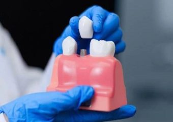 ایمپلنت بعد از کشیدن دندان | بهترین دندانپزشک اصفهان