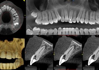 تفاوت اسکن CBCT و عکسبرداری پانوراما | بهترین ایمپلنت اصفهان
