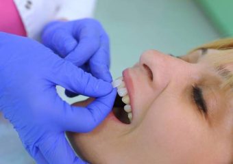 علت استفاده از لمینت فوری دندان | بهترین ایمپلنت اصفهان