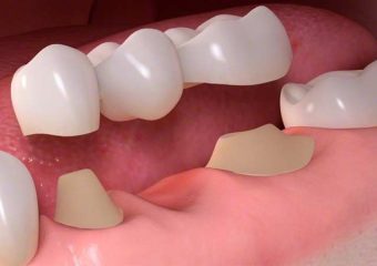 فواید Buildup (بازسازی دندان ) | بهترین ایمپلنت اصفهان