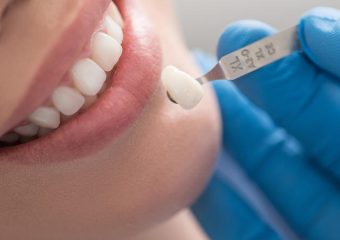 فواید لمینت فوری دندان | بهترین ایمپلنت اصفهان