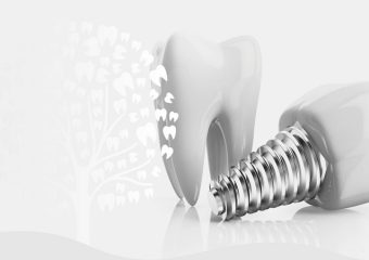 موارد تاثیرگذار در استحکام ایمپلنت دندان | بهترین دندانپزشک اصفهان