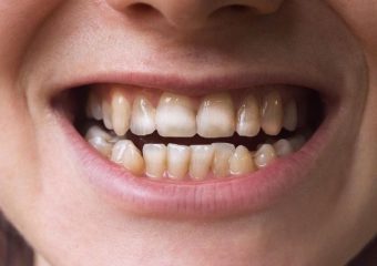 نامرتبی دندان ها | بهترین دندانپزشک اصفهان