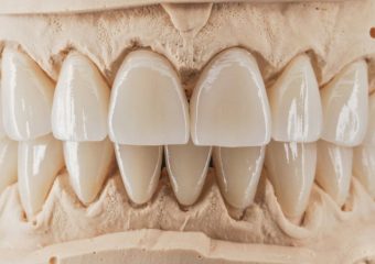 ویژگی های روکش زیرکونیا | بهترین دندانپزشک اصفهان