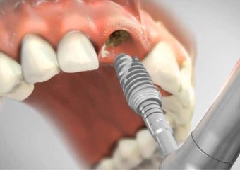 نکاتی برای کاشت ایمپلنت دندان جلو | بهترین دندانپزشک اصفهان | دکتر ندا مکانیک