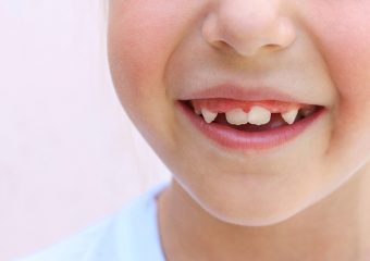 دلایل و درمان کجی دندان شیری | بهترین ایمپلنت اصفهان