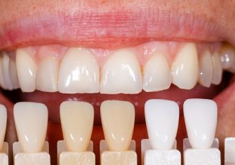 روش‌های پیشگیری از تغییر رنگ لمینت دندان | بهترین دندانپزشک زیبایی اصفهان