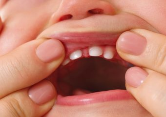 عوامل دیر درآمدن دندان شیری | بهترین ایمپلنت اصفهان