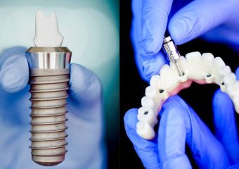 مزایای کاشت ایمپلنت دندان اشترومن | بهترین دندانپزشک اصفهان