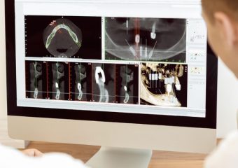 مقایسه ایمپلنت دیجیتال با ایمپلنت معمولی دندان | بهترین دندانپزشک اصفهان | دکتر ندا مکانیک