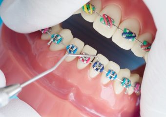 مقایسه کامپوزیت دندان با ارتودنسی | بهترین دندانپزشک زیبایی اصفهان