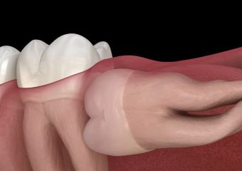 موارد ضروری برای کشیدن دندان عقل | بهترین دندانپزشک کودکان اصفهان