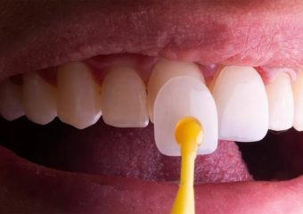 پاسخ به سوالاتی درمورد لمینت دندان و ارتودنسی | بهترین دندانپزشک زیبایی اصفهان