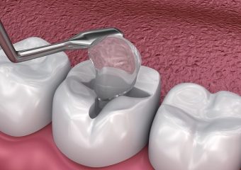 کاربردهای کامپوزیت نانوفیل در دندانپزشکی | بهترین دندانپزشک کودکان اصفهان