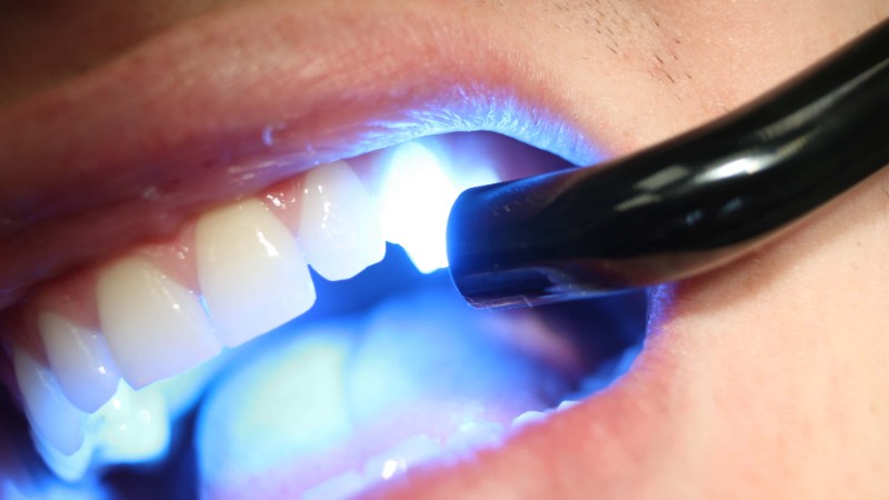 احساس درد بعد از کامپوزیت کردن دندان‌ | بهترین دندانپزشک زیبایی اصفهان | دکتر ندا مکانیک