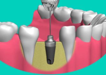 بهترین دندانپزشک اصفهان | دکتر ندا مکانیک