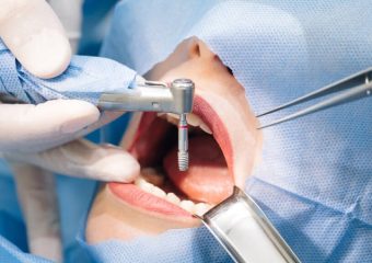 انواع ایمپلنت از نظر مراحل درمان| بهترین دندانپزشک کودکان اصفهان | دکتر ندا مکانیک