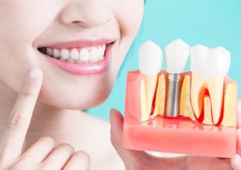 حفظ و نگهداری روکش ایمپلنت | بهترین دندانپزشک کودکان اصفهان | دکتر ندا مکانیک