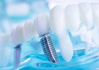 حفظ و نگهداری روکش ایمپلنت| بهترین دندانپزشک کودکان اصفهان | دکتر ندا مکانیک