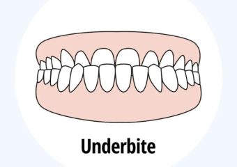 درمان جلو بودن فک با ونیر کامپوزیت | بهترین دندانپزشک کودکان اصفهان