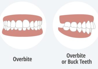 سن مناسب برای درمان بیرون‌زدگی فک | بهترین دندانپزشک کودکان اصفهان | دکتر ندا مکانیک