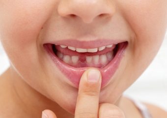 علل نیاز به عصب کشی دندان شیری | بهترین ایمپلنت اصفهان | دکتر ندا مکانیک