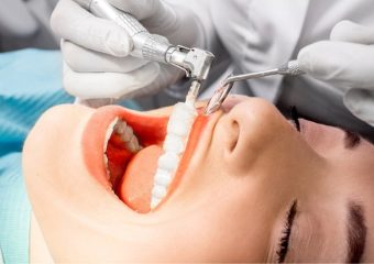 عوارض احتمالی جرم گیری دندان | بهترین دندانپزشک زیبایی اصفهان | دکتر ندا مکانیک