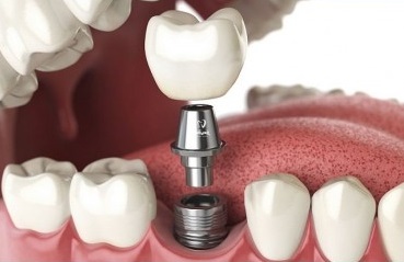 ایمپلنت بایوهورایزن چیست؟| بهترین دندانپزشک اصفهان - بهترین ایمپلنت اصفهان - بهترین دندانپزشک زیبایی اصفهان - بهترین دندانپزشک کودکان اصفهان