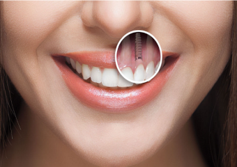 ایمپلنت دندان پیش چیست؟ | بهترین دندانپزشک اصفهان - بهترین ایمپلنت اصفهان - بهترین دندانپزشک زیبایی اصفهان - بهترین دندانپزشک کودکان اصفهان