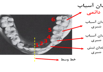 ایمپلنت دندان 5 چیست؟ |بهترین دندانپزشک اصفهان - بهترین ایمپلنت اصفهان - بهترین دندانپزشک زیبایی اصفهان - بهترین دندانپزشک کودکان اصفهان