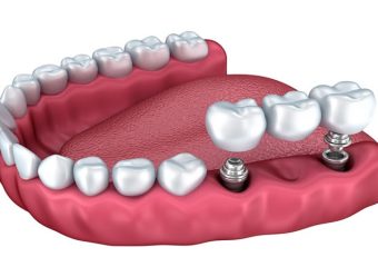 فرق ایمپلنت با دندان ثابت | بهترین دندانپزشک اصفهان - بهترین ایمپلنت اصفهان - بهترین دندانپزشک زیبایی اصفهان - بهترین دندانپزشک کودکان اصفهان