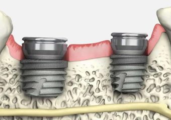 ایمپلنت بايوهورايزن چیست؟| بهترین دندانپزشک اصفهان - بهترین ایمپلنت اصفهان - بهترین دندانپزشک زیبایی اصفهان - بهترین دندانپزشک کودکان اصفهان