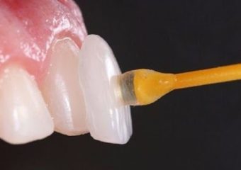 باز شدن چسب لمینت دندان| بهترین ایمپلنت اصفهان | دکتر ندا مکانیک