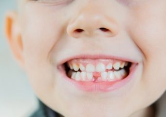 عوارض کشیدن دندان شیری کودکان| بهترین دندانپزشک اصفهان | دکتر ندا مکانیک