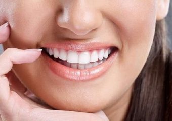 لمینت سرامیکی ایمکس چیست؟| بهترین دندانپزشک زیبایی اصفهان |دکتر ندا مکانیک