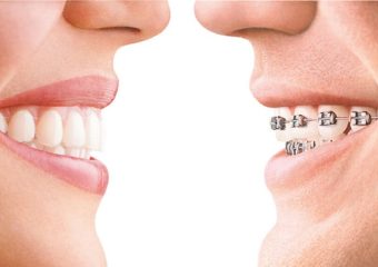 مقایسه ارتودنسی با کامپوزیت | بهترین دندانپزشک زیبایی اصفهان | دکتر ندا مکانیک