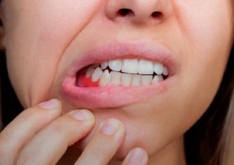 مراحل بیماری لثه چیست؟ | بهترین دندانپزشک اصفهان - بهترین ایمپلنت اصفهان - بهترین دندانپزشک زیبایی اصفهان - بهترین دندانپزشک کودکان اصفهان