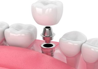 مراحل کاشت ایمپلنت مدنتیکا چگونه است؟ | بهترین دندانپزشک اصفهان - بهترین ایمپلنت اصفهان - بهترین دندانپزشک زیبایی اصفهان - بهترین دندانپزشک کودکان اصفهان