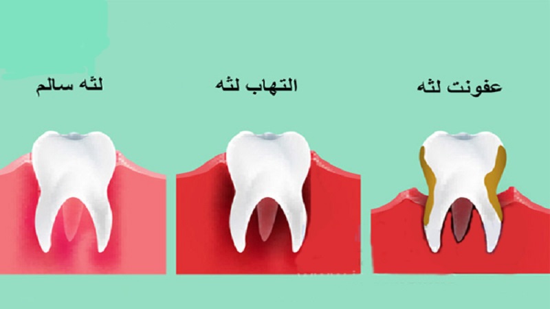 علائم و راه های پیشگیری از بیماری لثه | بهترین دندانپزشک اصفهان - بهترین ایمپلنت اصفهان - بهترین دندانپزشک زیبایی اصفهان - بهترین دندانپزشک کودکان اصفهان