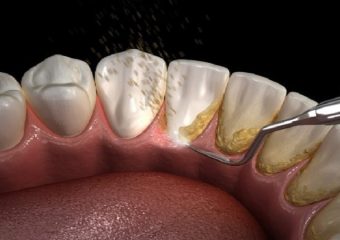 علت ایجاد جرم روی دندان | بهترین دندانپزشک اصفهان - بهترین ایمپلنت اصفهان - بهترین دندانپزشک زیبایی اصفهان - بهترین دندانپزشک کودکان اصفهان