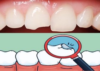 ترمیم دندان شکسته یا ترک خورده چیست؟ | بهترین دندانپزشک اصفهان - بهترین ایمپلنت اصفهان - بهترین دندانپزشک زیبایی اصفهان - بهترین دندانپزشک کودکان اصفهان