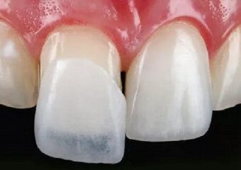 مراحل کامپوزیت روی دندان عصب کشی شده | بهترین دندانپزشک اصفهان - بهترین ایمپلنت اصفهان - بهترین دندانپزشک زیبایی اصفهان - بهترین دندانپزشک کودکان اصفهان