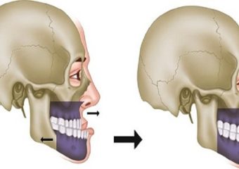 انواع جراحی فک | بهترین دندانپزشک اصفهان - بهترین ایمپلنت اصفهان - بهترین دندانپزشک زیبایی اصفهان - بهترین دندانپزشک کودکان اصفهان